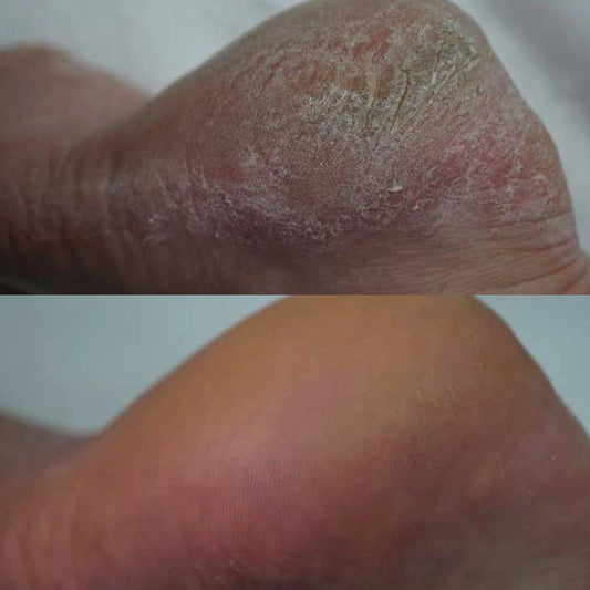Avant - Après mousse crème Footlogix F1 DD, urée, hydratation, pieds doux, protection