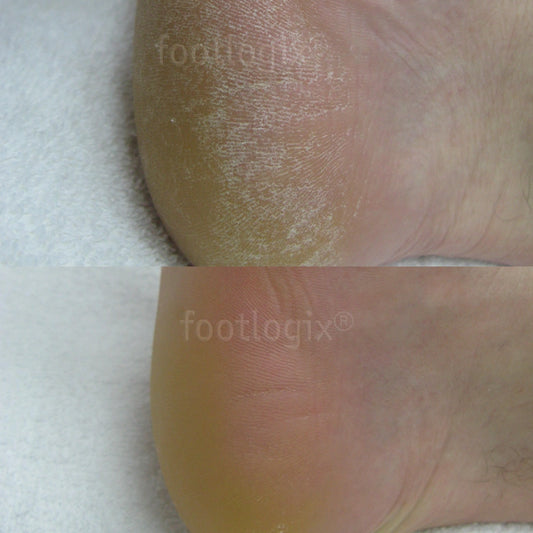 Avant - après mousse Footlogix F2, soin quotidien, peaux normales à sèches, hydratant, pieds