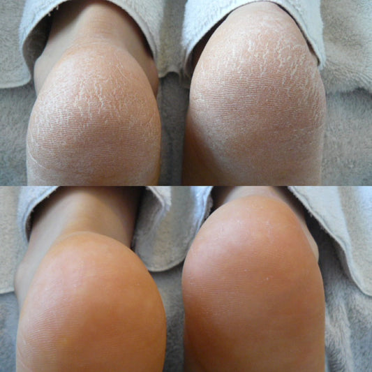 Avant - Après mousse Footlogix F3, peau très sèche, hydratation intense, pieds diabétiques