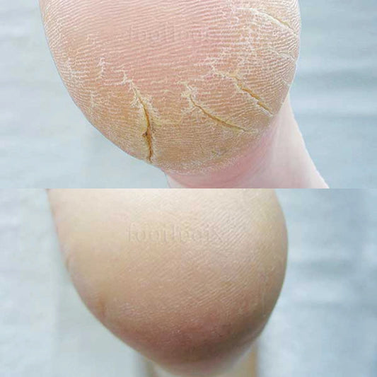 Avant - après mousse Footlogix F3+, peau craquelée, pieds secs, callosités