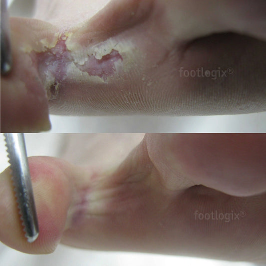 Avant - Après mousse Footlogix F7, peau qui pèle, antifongique, Clotrimazole, pied d’athlète