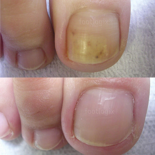 Avant -Après Spray antifongique, Footlogix F7T, Clotrimazole, mycoses, pieds