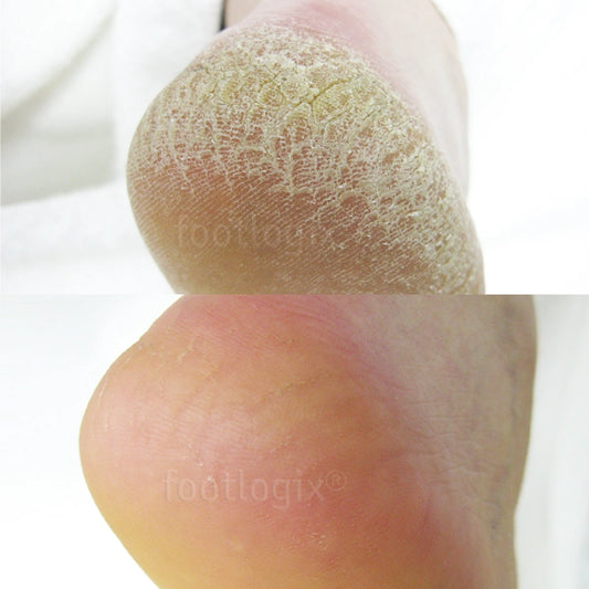 Avant - Après mousse Footlogix F7+, peau rugueuse, hydratante, antifongique, pieds secs
