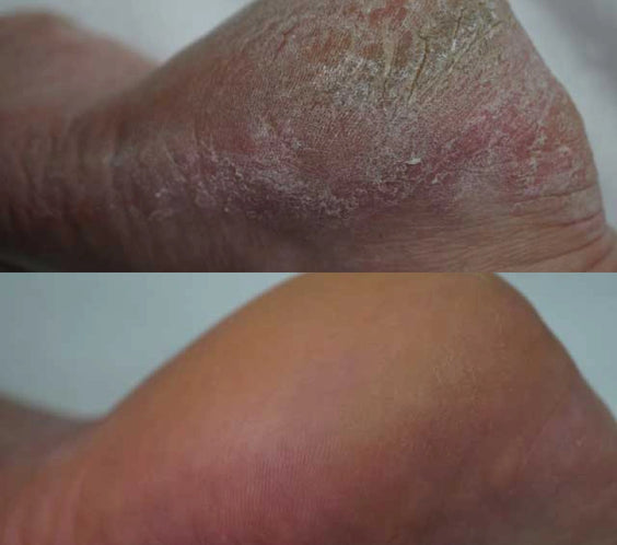 Avant - Après mousse crème Footlogix F1 DD, urée, hydratation, pieds doux, protection