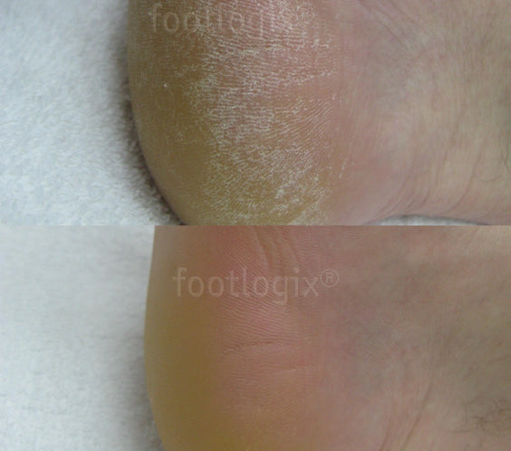 Avant - après mousse Footlogix F2, soin quotidien, peaux normales à sèches, hydratant, pieds