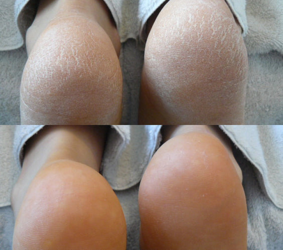 Avant - Après mousse Footlogix F3, peau très sèche, hydratation intense, pieds diabétiques