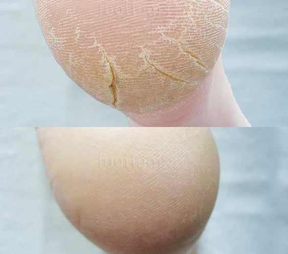 Avant - après mousse Footlogix F3+, peau craquelée, pieds secs, callosités