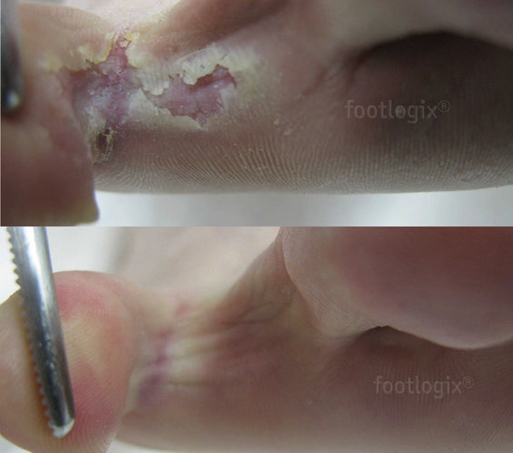 Avant - Après mousse Footlogix F7, peau qui pèle, antifongique, Clotrimazole, pied d’athlète