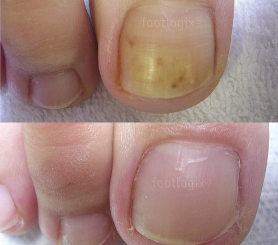 Avant -Après Spray antifongique, Footlogix F7T, Clotrimazole, mycoses, pieds