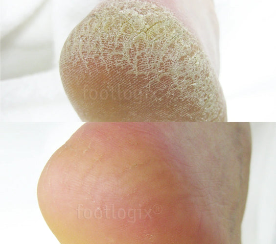 Avant - Après mousse Footlogix F7+, peau rugueuse, hydratante, antifongique, pieds secs